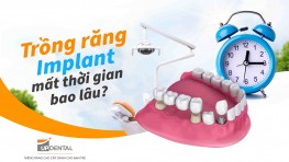 Trồng răng Implant mất thời gian bao lâu?