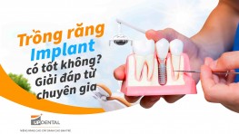 Trồng răng Implant có tốt không? Giải đáp từ chuyên gia