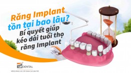 Răng Implant tồn tại bao lâu? Bí quyết giúp kéo dài tuổi thọ răng Implant