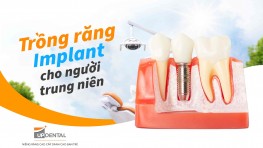 Trồng răng Implant cho người trung niên