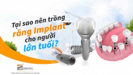 Tại sao nên trồng răng Implant cho người lớn tuổi?