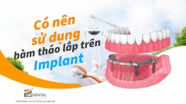 Có nên sử dụng hàm tháo lắp trên Implant?