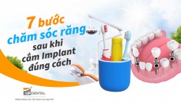 7 bước chăm sóc răng sau khi cắm Implant đúng cách