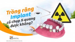 Trồng răng Implant có chụp X-quang được không?