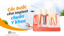 Các bước cắm Implant chuẩn Y khoa