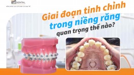 Giai đoạn tinh chỉnh trong niềng răng quan trọng thế nào?