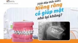 [Giải đáp] Niềng răng có giúp mặt nhỏ lại không?