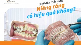 [Giải đáp thắc mắc] Niềng răng có hiệu quả không?