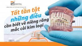 Tất tần tật những điều cần biết về niềng răng mắc cài kim loại