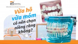 Vừa hô vừa móm có nên chọn niềng răng không?