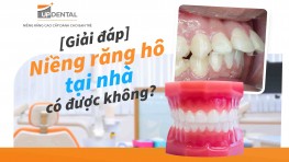 [Giải đáp] Niềng răng hô tại nhà có được không?