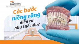 Các bước niềng răng diễn ra như thế nào?