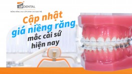 Cập nhật giá niềng răng mắc cài pha lê hiện nay