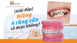 [Giải đáp] Niềng 4 răng cửa có được không? 