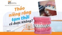 Tháo niềng răng tạm thời có được không?