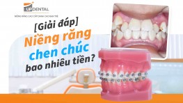 [Thắc mắc] Niềng răng chen chúc bao nhiêu tiền?