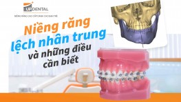 Niềng răng lệch nhân trung và những điều cần biết