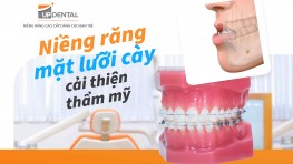 Niềng răng mặt lưỡi cày cải thiện thẩm mỹ