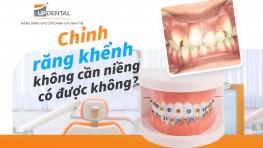 Chỉnh răng khểnh không cần niềng có được không?