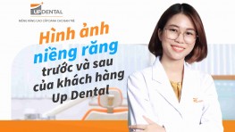 Hình ảnh niềng răng trước và sau của khách hàng Up Dental