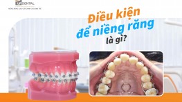 [Thắc mắc] Điều kiện để niềng răng là gì?