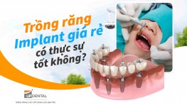 Trồng răng Implant giá rẻ có thực sự tốt không? 