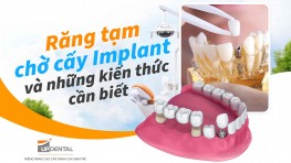 Răng tạm chờ cấy Implant và những kiến thức cần biết