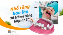 Nhổ răng bao lâu thì trồng răng Implant