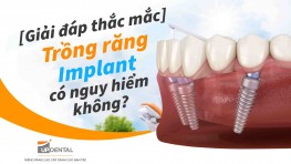 [Giải đáp thắc mắc] - Trồng răng Implant có nguy hiểm không?