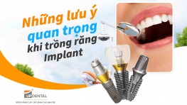 Những lưu ý quan trọng khi trồng răng Implant