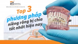 Top 3 phương pháp niềng răng bị chìa tốt nhất hiện nay