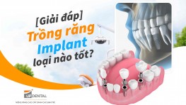 [Giải đáp] Trồng răng Implant loại nào tốt? 