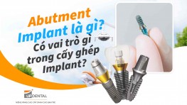 Abutment Implant là gì? Có vai trò gì trong cấy ghép Implant?