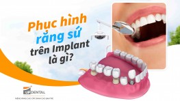 Phục hình răng sứ trên Implant là gì? 