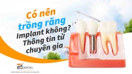 Có nên trồng răng Implant không? - Thông tin từ chuyên gia