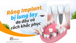 Răng Implant bị lung lay do đâu và cách khắc phục