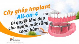 Cấy ghép Implant All-on-4 - Bí quyết làm đẹp cho người mất răng toàn hàm