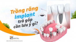 Trồng răng Implant trả góp cần lưu ý gì?