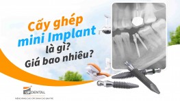 Cấy ghép mini Implant là gì? Cấy ghép mini Implant giá bao nhiêu?