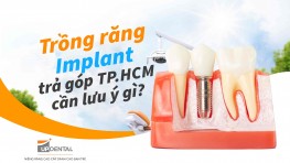 Trồng răng Implant trả góp TP.HCM cần lưu ý gì?