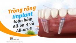 Trồng răng Implant toàn hàm All-on-4 và All-on-6