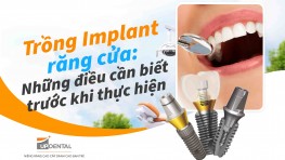 Trồng Implant răng cửa: Những điều cần biết trước khi thực hiện