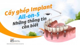 Cấy ghép Implant all-on-5 - Những thông tin cần biết