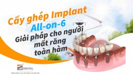 Cấy ghép Implant all-on-6 - Giải pháp cho người mất răng toàn hàm