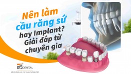 Nên làm cầu răng sứ hay Implant? Giải đáp từ chuyên gia