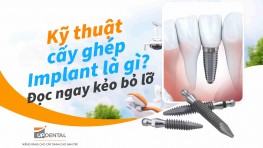 Kỹ thuật cấy ghép Implant là gì? Đọc ngay kẻo bỏ lỡ