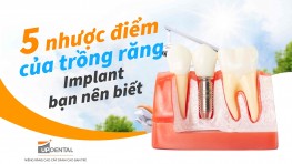 5 nhược điểm của trồng răng Implant bạn nên biết