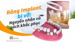 Răng Implant bị vỡ: Nguyên nhân và cách khắc phục