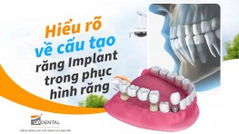 Hiểu rõ về cấu tạo răng Implant trong phục hình răng