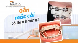 [Giải đáp] - Gắn mắc cài có đau không?